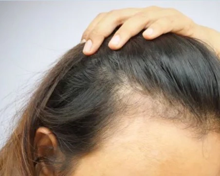 Експериментален серум може да възстанови косата след оплешивяване