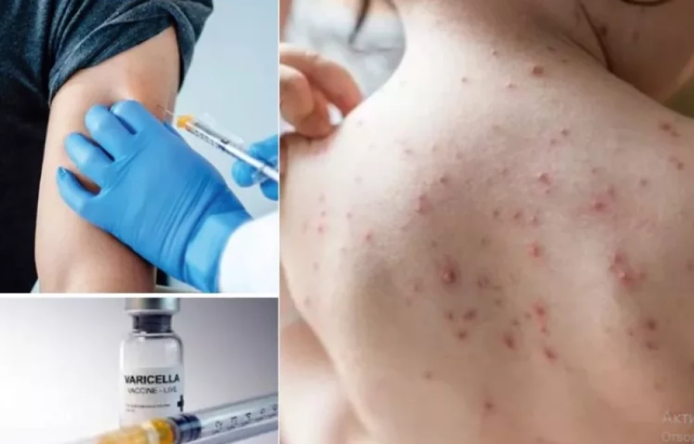 Ваксината срещу варицела влиза в имунизационния календар