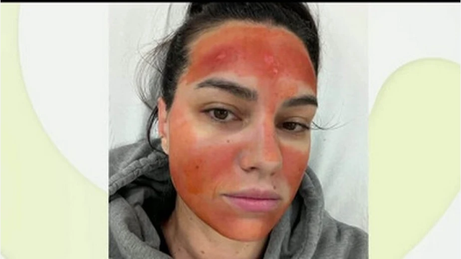 „Билков пилинг