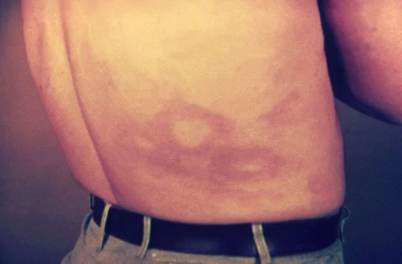 Регистрирани са 4 случая на проказа в Европа