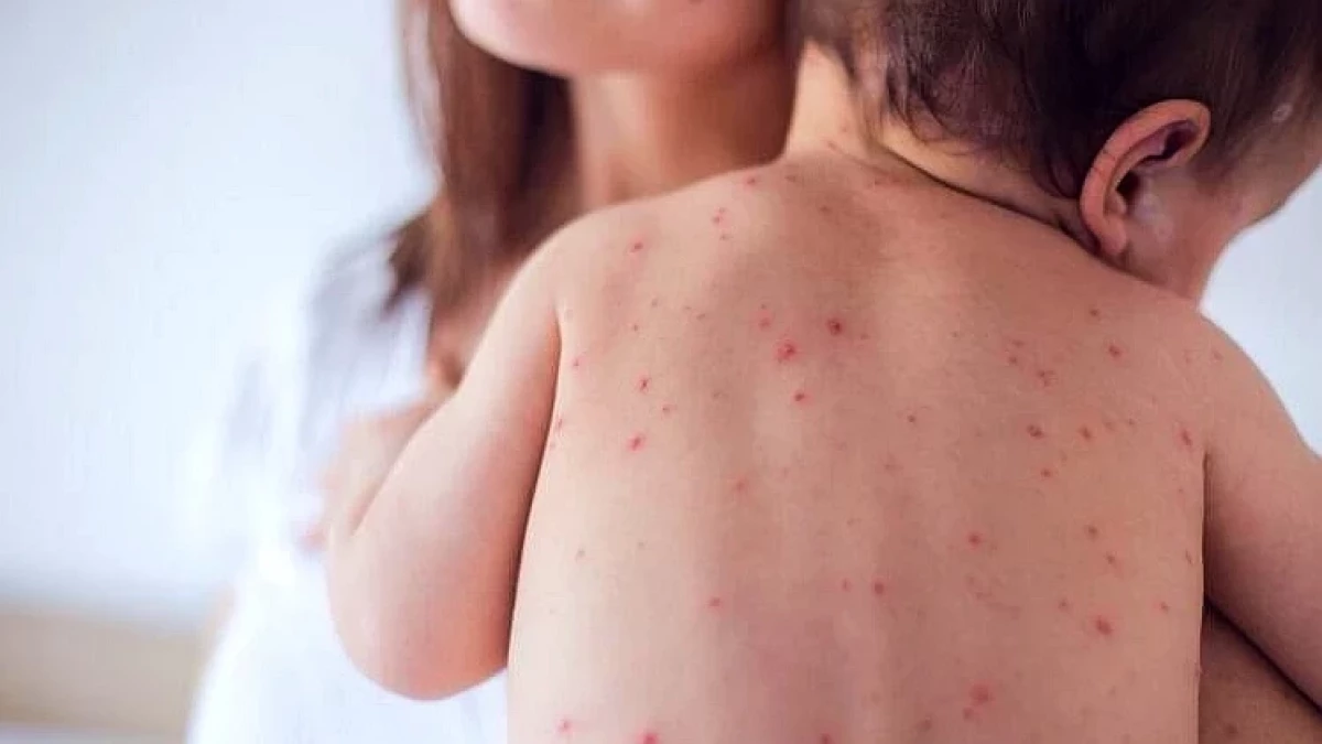 Д-р Сотиров: Неимунизираните деца са изложени на тежки последици от морбили