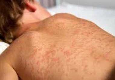 Случаите на морбили в страната продължават да се увеличават но