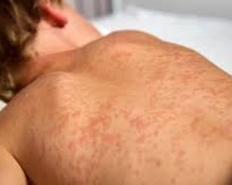 Пловдивски лекар: Родителите, отказали ваксина срещу морбили, да поемат лечението