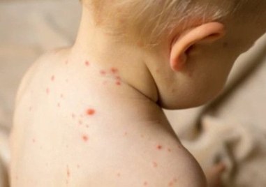 Пловдивски лекар: Родителите, отказали ваксина срещу морбили, да поемат лечението