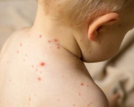 Пловдивски лекар: Родителите, отказали ваксина срещу морбили, да поемат лечението