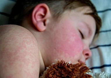 Болните от морбили у нас са общо 101, 89% от тях са деца