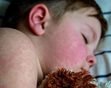 Болните от морбили у нас са общо 101, 89% от тях са деца