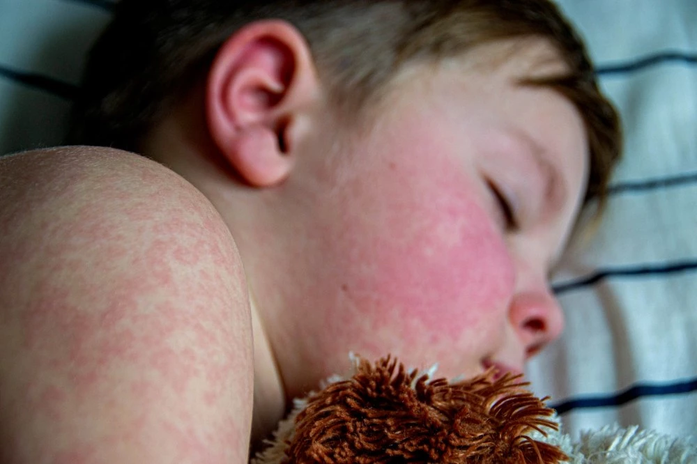 Болните от морбили у нас са общо 101, 89% от тях са деца