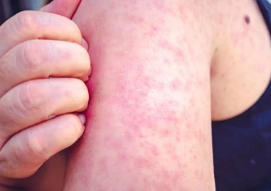 Само за седмица: Новите случаи на морбили са 30