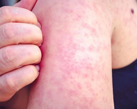 Само за седмица: Новите случаи на морбили са 30