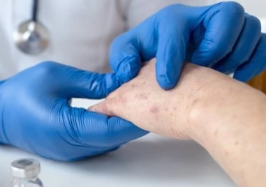 Общо 132 случая на морбили у нас - най-голямото огнище е във Враца