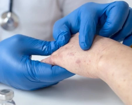 Общо 132 случая на морбили у нас - най-голямото огнище е във Враца