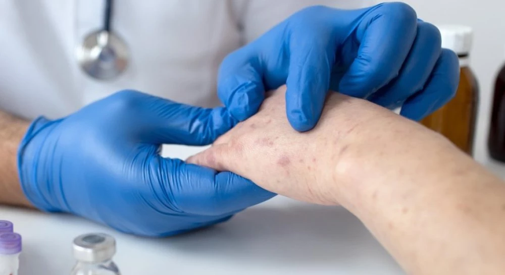 Общо 132 случая на морбили у нас - най-голямото огнище е във Враца