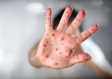 Расте броят на случаите на морбили у нас