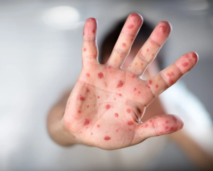 Расте броят на случаите на морбили у нас