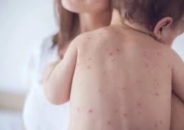 Шест нови случая на морбили са регистрирани в страната