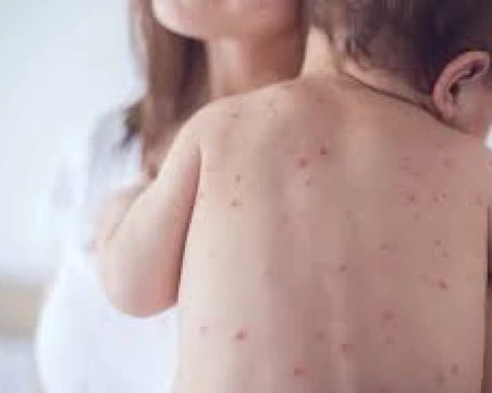 Шест нови случая на морбили са регистрирани в страната