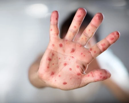 Общо 16 нови случая на морбили са регистрирани в страната, заболелите вече са 191 души